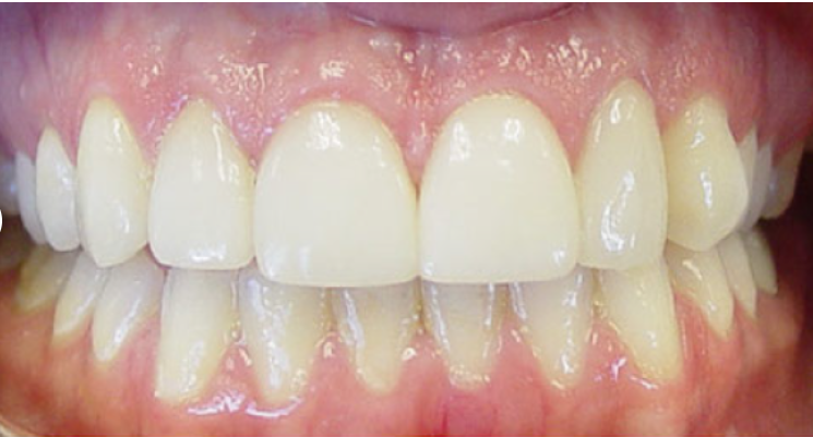Crown lengthening after treatment